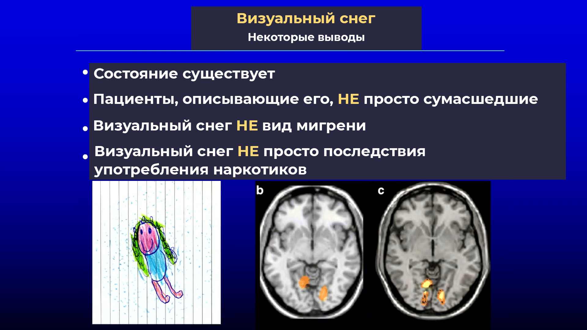 Синдром визуального снега картинки